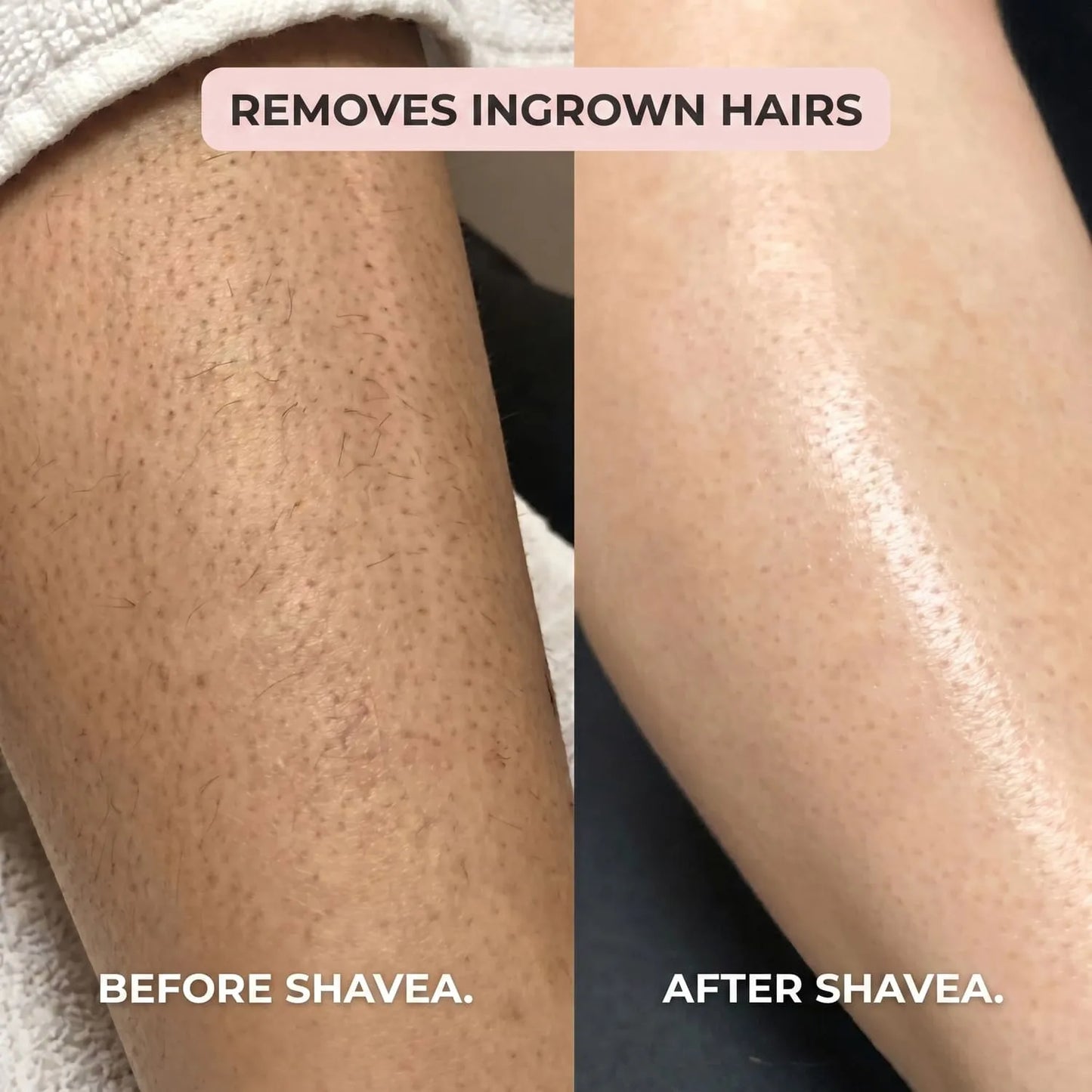 Shavea™ 2-in-1 Bikini & Body Hair Remover
